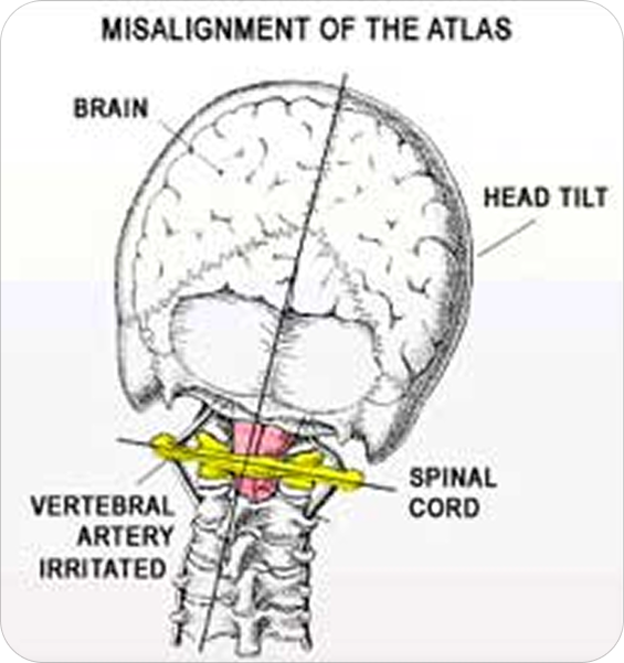 Misalignment of Atlas Bone