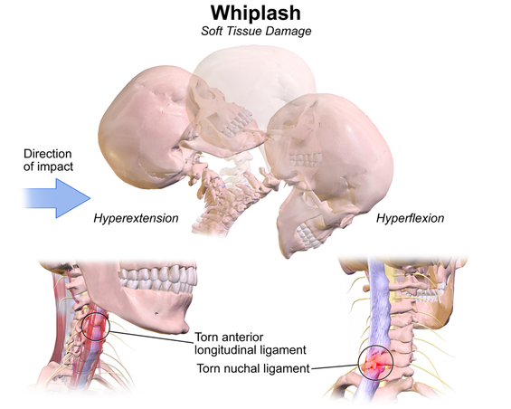 Whiplash Chiropractor